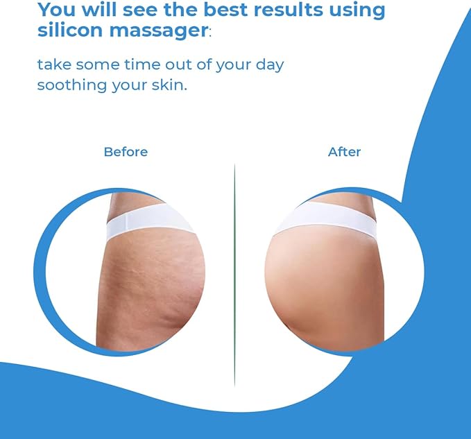 Anti Cellulite Massager Roller - Anticellulite Fascia Blaster for Cellulite Remover - Improves Blood Flow Use Cellulite Brush & Cellulite Roller with Cream or Oil for Cellulite Treatment